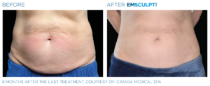 Emsculpt Neo PIC Ba card female abdomen 139 ENUS100