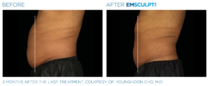 Emsculpt Neo PIC Ba card male lateral abdomen 148 ENUS100